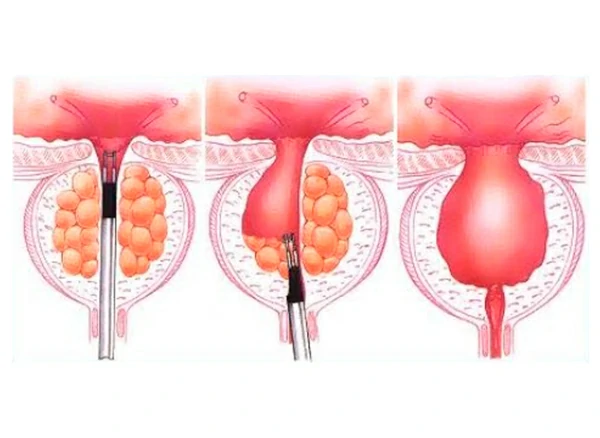 reseccion transuretral de prostata