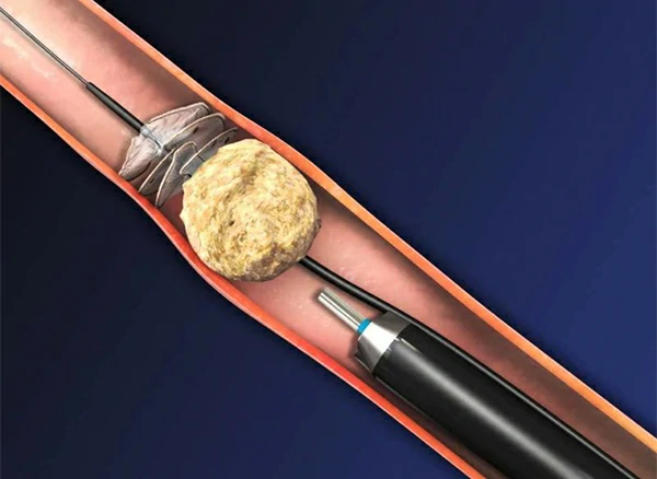 ureterolitotricia laser