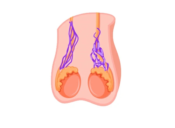 cirugia de varicocele