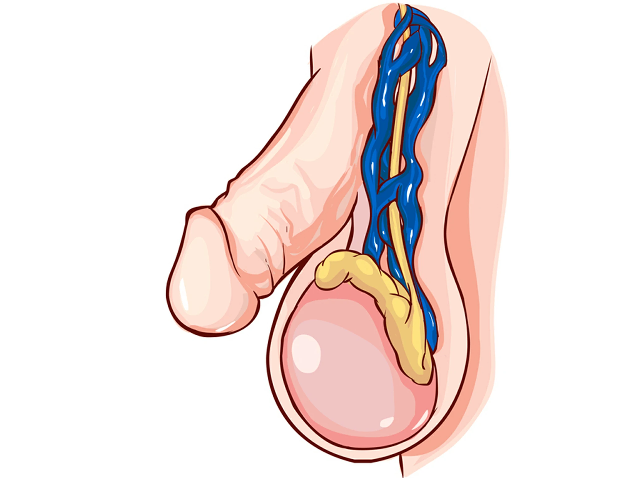 varicocele