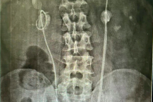 procedimeinto urologico